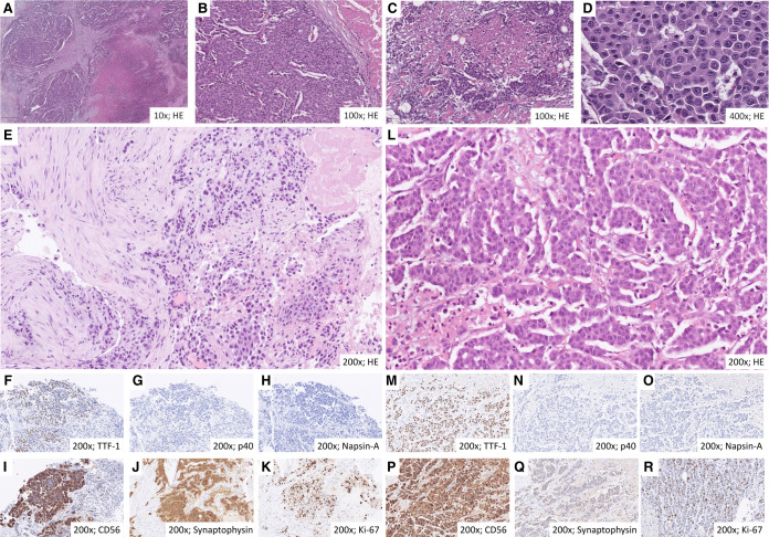 Lorlatinib and compound mutations in ALK+ large-cell neuroendocrine lung carcinoma: a case report.