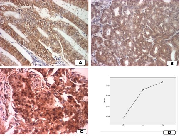 Snail Immunoexpression in Endometrioid Endometrial Carcinomas.