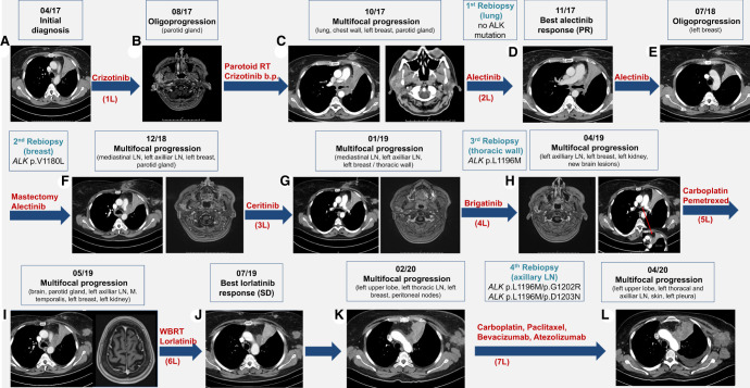 Lorlatinib and compound mutations in ALK+ large-cell neuroendocrine lung carcinoma: a case report.