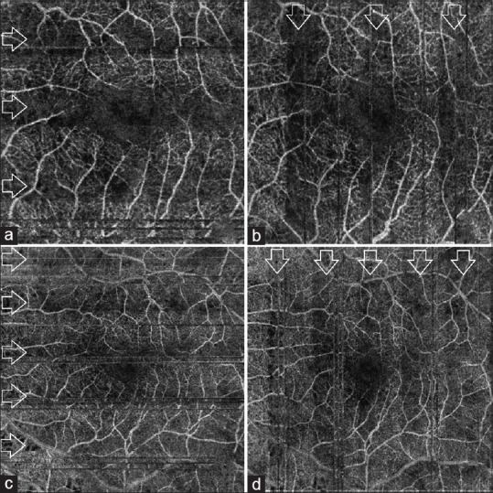 Pulsatile Ocular Blood Flow Registered with Optical Coherence Tomography Angiography in Patients with High Intraocular Pressure.