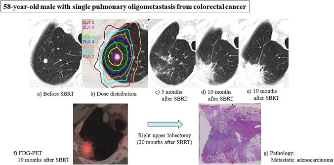 Stereotactic body radiation therapy for metastatic lung metastases.