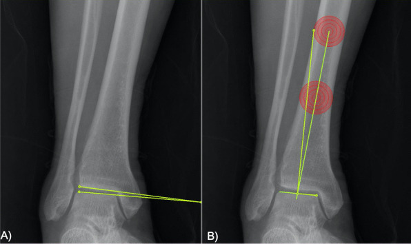 Decision-making factors and their thresholds for total knee arthroplasty in lateral tibiofemoral osteoarthritis patients: a retrospective cohort study.