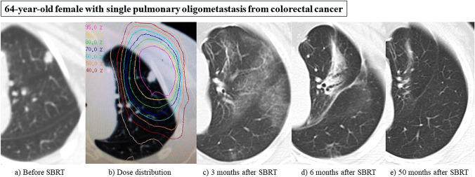 Stereotactic body radiation therapy for metastatic lung metastases.