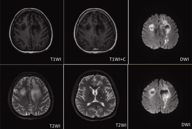 Progressive Multifocal Leukoencephalopathy in a Patient with Systemic Lupus Erythematosus.