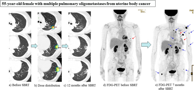 Stereotactic body radiation therapy for metastatic lung metastases.