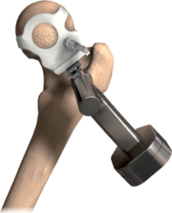 Does functional planning, 3D templating and patient-specific instrumentation improve accuracy in total hip replacement?- a randomized controlled trial.