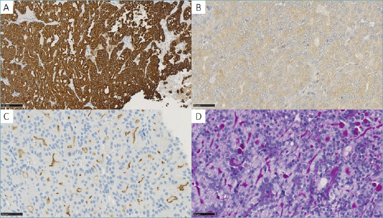 DOG-1 positive primary acinic cell carcinoma of the lung and investigation of molecular status.