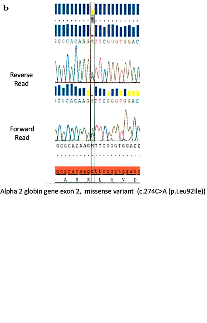 Hemoglobin Alpha Chain Variant Zara Associated With Familial Asymptomatic Hypoxemia.