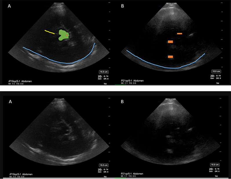 Exploratory study to assess feasibility of intracerebral hemorrhage detection by point of care cranial ultrasound.