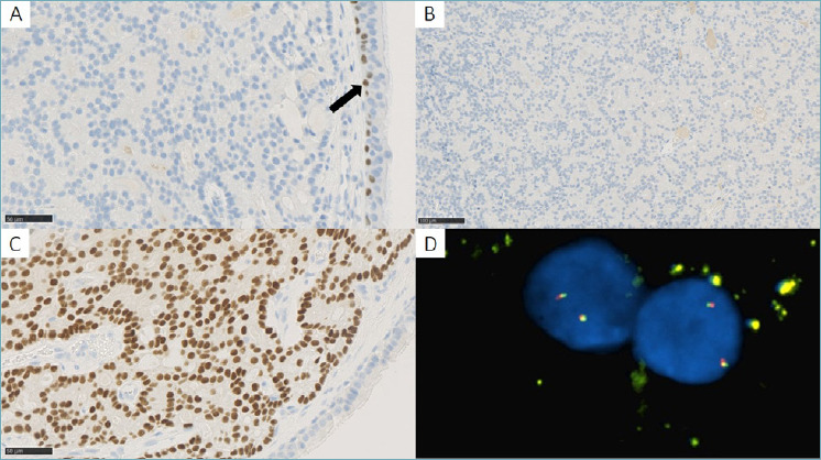 DOG-1 positive primary acinic cell carcinoma of the lung and investigation of molecular status.