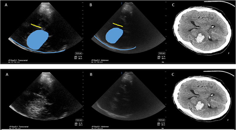 Exploratory study to assess feasibility of intracerebral hemorrhage detection by point of care cranial ultrasound.