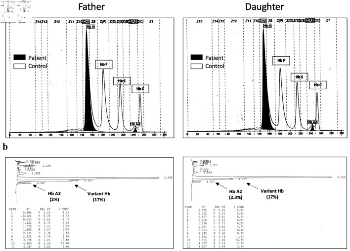 Hemoglobin Alpha Chain Variant Zara Associated With Familial Asymptomatic Hypoxemia.