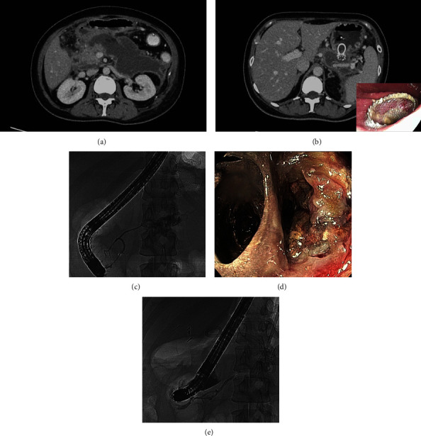 Drainage of Complex Walled-Off Pancreatic Fluid Collections in LAMS Era: A Multicenter Study.