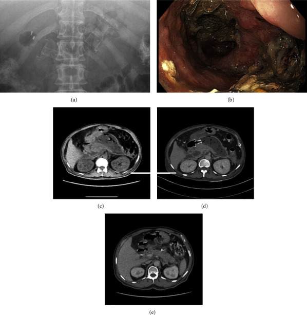 Drainage of Complex Walled-Off Pancreatic Fluid Collections in LAMS Era: A Multicenter Study.