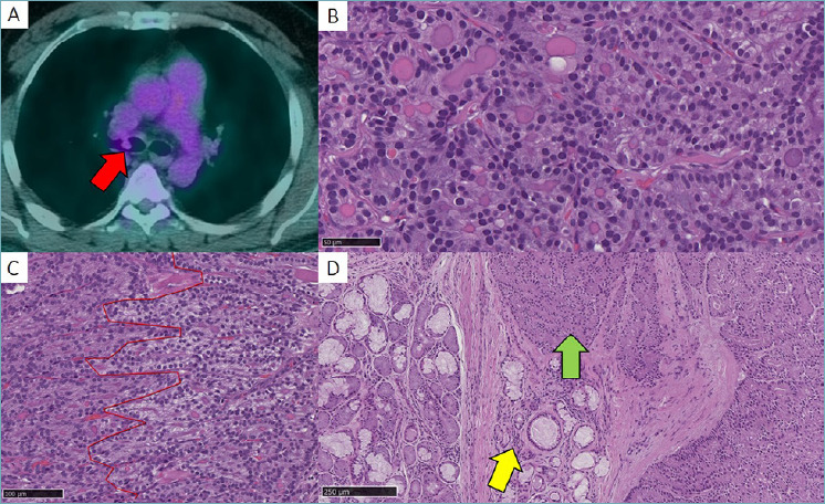 DOG-1 positive primary acinic cell carcinoma of the lung and investigation of molecular status.