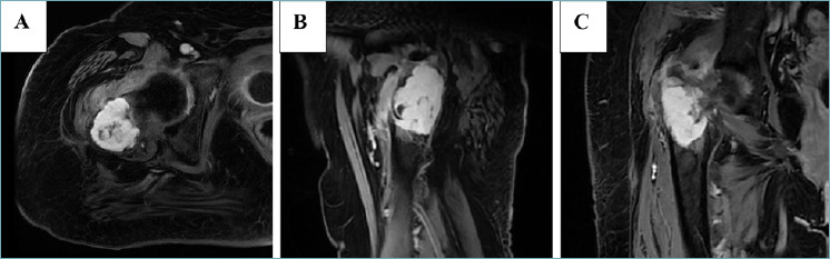 Primary intraosseous solitary fibrous tumor: an extremely rare case report and brief review of the literature.