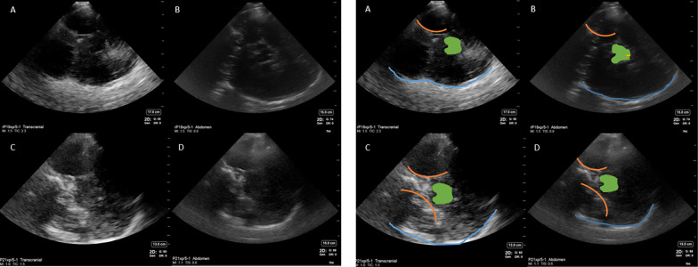 Exploratory study to assess feasibility of intracerebral hemorrhage detection by point of care cranial ultrasound.