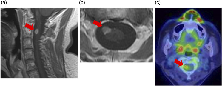 Glioblastoma, IDH-wildtype with leptomeningeal metastasis to Meckel's cave: A case report.