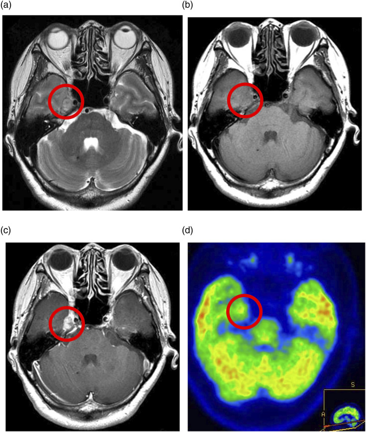 Glioblastoma, IDH-wildtype with leptomeningeal metastasis to Meckel's cave: A case report.