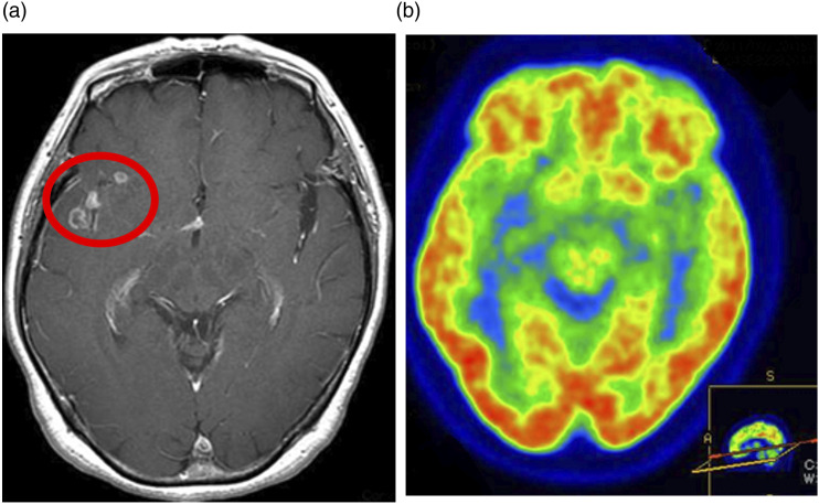 Glioblastoma, IDH-wildtype with leptomeningeal metastasis to Meckel's cave: A case report.