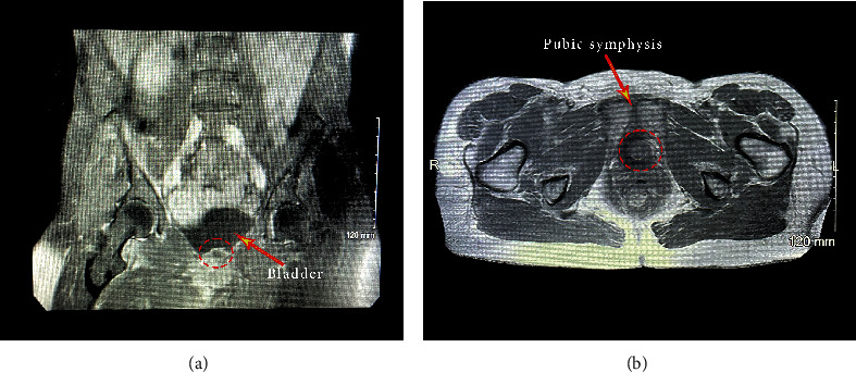 A Rare Case of a Bladder Neck Abscess Masquerading as a Benign Mass.