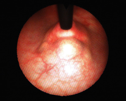 A Rare Case of a Bladder Neck Abscess Masquerading as a Benign Mass.