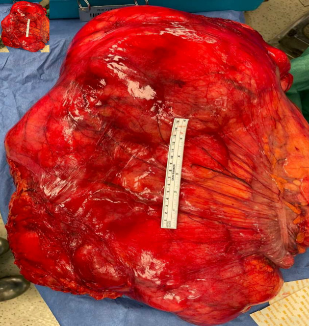 Retroperitoneal Liposarcoma: The Giant Type.