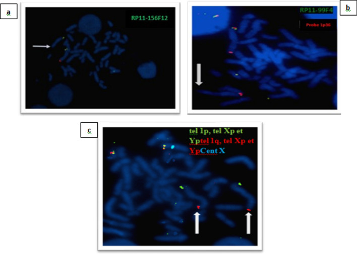 Clinical and molecular characterization of 1q43q44 deletion and corpus callosum malformations: 2 new cases and literature review.