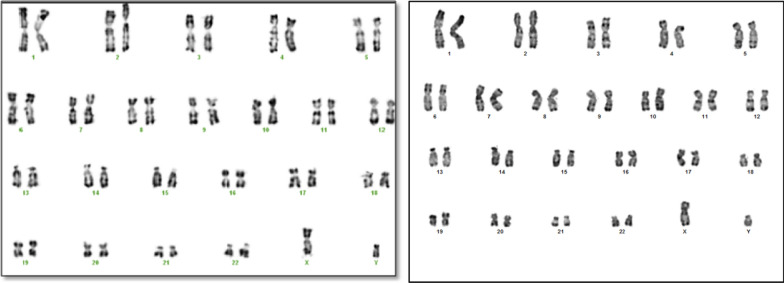 Clinical and molecular characterization of 1q43q44 deletion and corpus callosum malformations: 2 new cases and literature review.