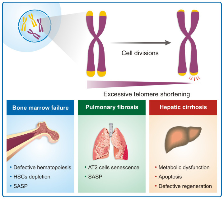 Recent advances in understanding telomere diseases.