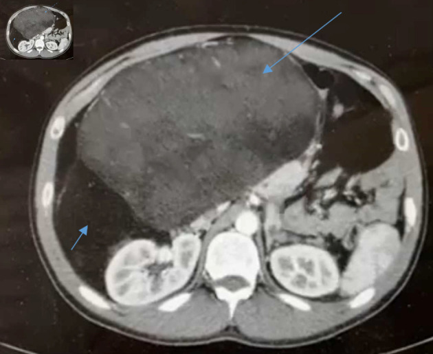 Retroperitoneal Liposarcoma: The Giant Type.