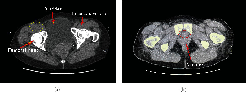 A Rare Case of a Bladder Neck Abscess Masquerading as a Benign Mass.