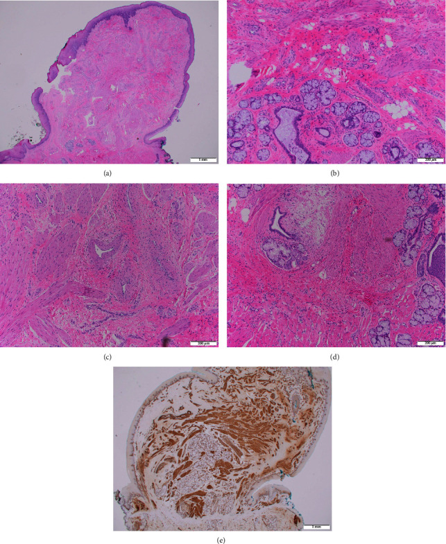 A Case of an Infantile Lingual Leiomyomatous Hamartoma.