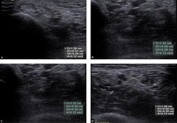 Role of High-resolution Ultrasonography in the Evaluation of the Tibial and Median Nerves in Diabetic Peripheral Neuropathy.