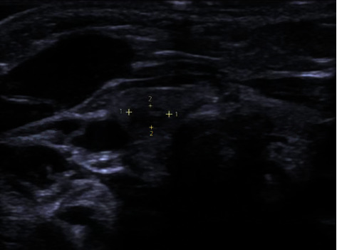 A Case of an Infantile Lingual Leiomyomatous Hamartoma.