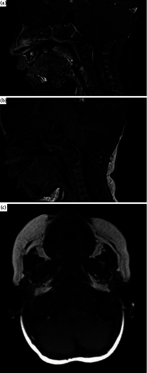 A Case of an Infantile Lingual Leiomyomatous Hamartoma.