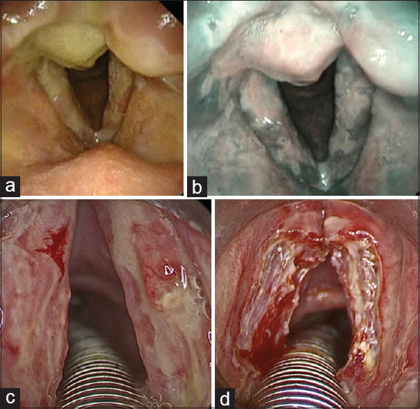 Primary non-Hodgkin's lymphoma of the larynx.