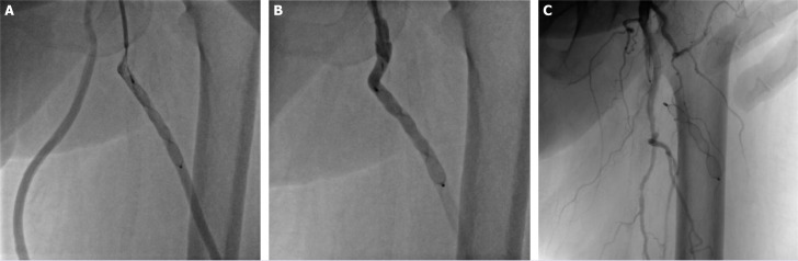 Endovascular closure of an arterivenous graft for dialysis-associated steal syndrome of lower extremity.