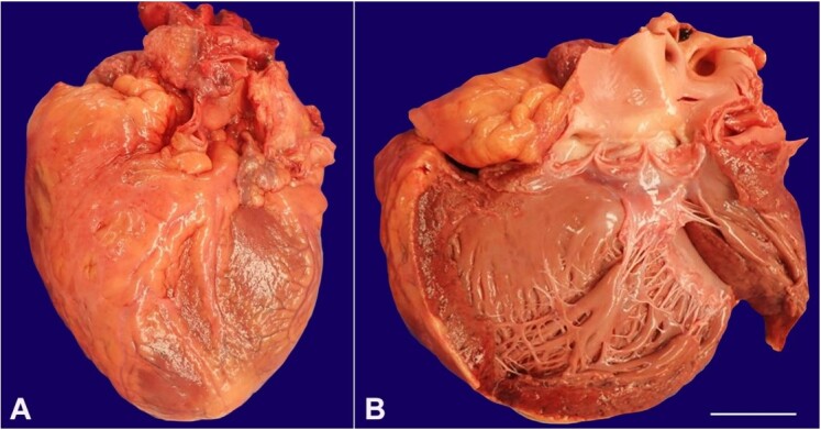 Complexities and complications of extreme obesity.