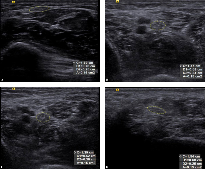 Role of High-resolution Ultrasonography in the Evaluation of the Tibial and Median Nerves in Diabetic Peripheral Neuropathy.