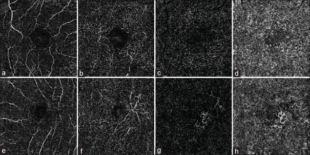 Is Type 2 Macular Telangiectasia a Bilateral and Symmetrical Disease Entity?