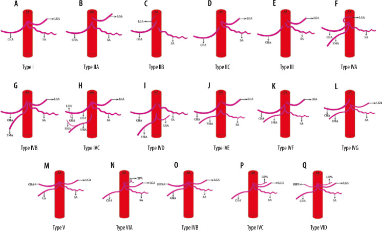 Newly proposed classification of celiac artery variations based on embryology and correlation with computed tomography angiography.