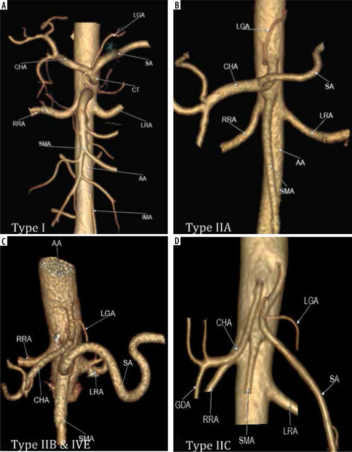 Newly proposed classification of celiac artery variations based on embryology and correlation with computed tomography angiography.