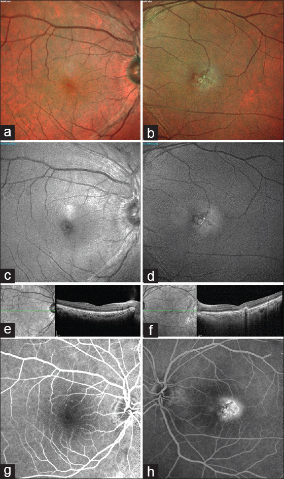 Is Type 2 Macular Telangiectasia a Bilateral and Symmetrical Disease Entity?