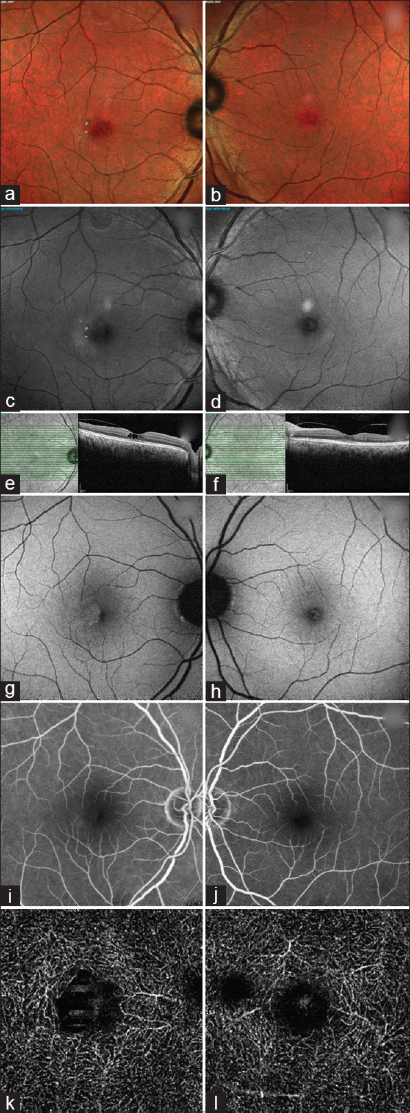 Is Type 2 Macular Telangiectasia a Bilateral and Symmetrical Disease Entity?