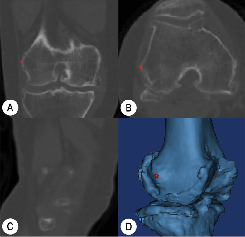 Could surgical transepicondylar axis be identified accurately in preoperative 3D planning for total knee arthroplasty? A reproducibility study based on 3D-CT.