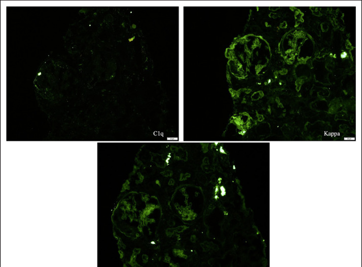 Antineutrophil Cytoplasmic Autoantibody-Negative Pauci-Immune Crescentic Glomerulonephritis in a Patient with Systemic Lupus Erythematosus.