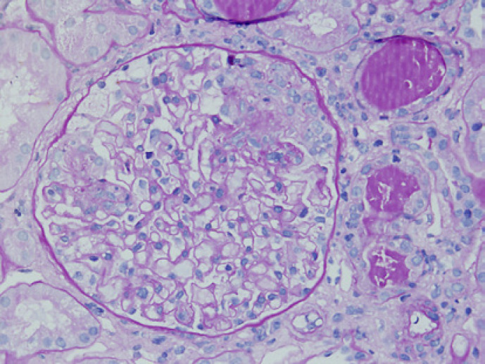 Antineutrophil Cytoplasmic Autoantibody-Negative Pauci-Immune Crescentic Glomerulonephritis in a Patient with Systemic Lupus Erythematosus.