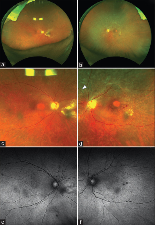 Hypertension: A Cause of Bilateral Proliferative Retinopathy.