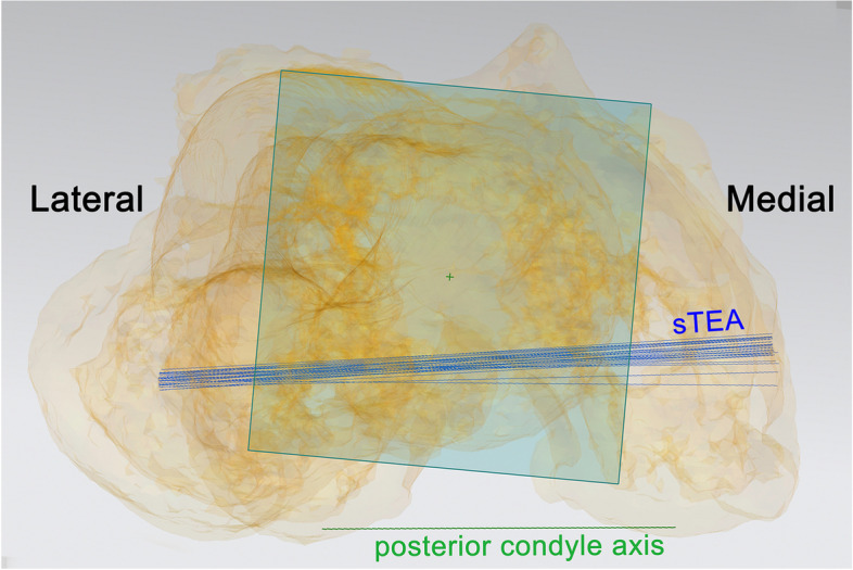 Could surgical transepicondylar axis be identified accurately in preoperative 3D planning for total knee arthroplasty? A reproducibility study based on 3D-CT.